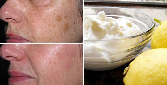 Come eliminare le macchie della pelle per sempre con limone e yogurt