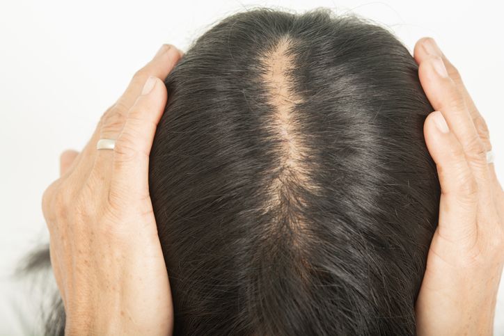 5 alimenti da evitare per non avere capelli grassi