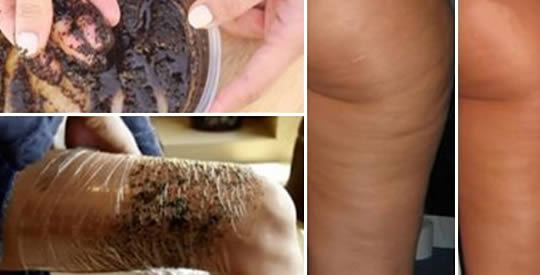 Come sbarazzarsi della cellulite per sempre con un impacco di caffè