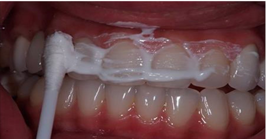 Il rimedio naturale per sbiancare i denti in 15 minuti