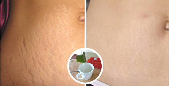 Come eliminare le smagliature con il caffè