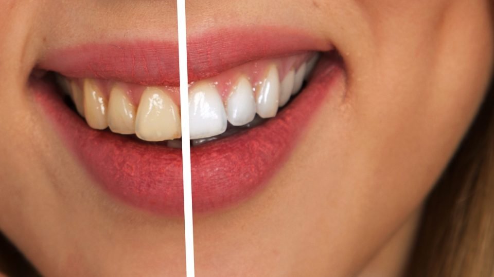 Ecco come eliminare tutto il tartaro ed avere dei denti bianchissimi